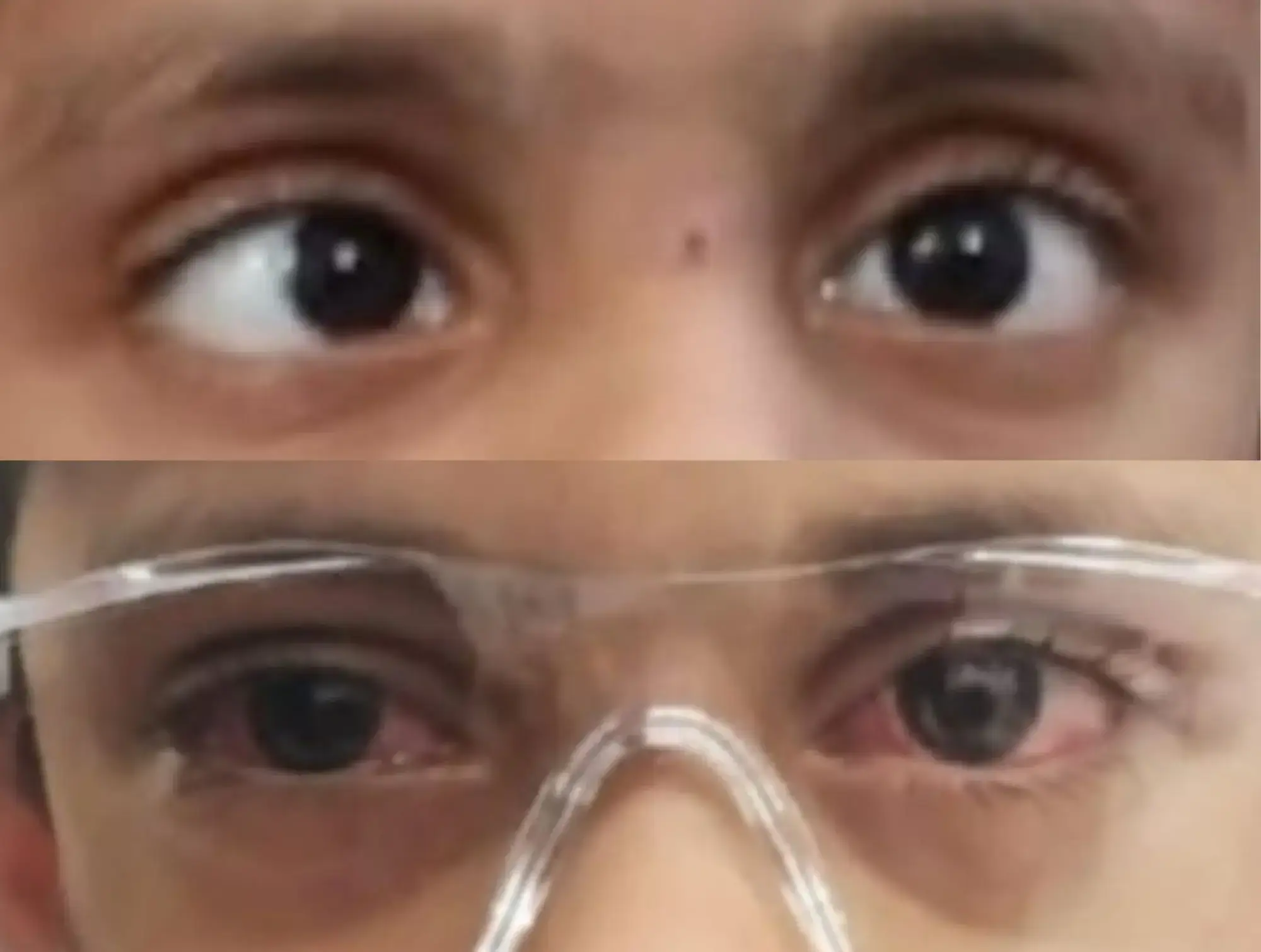 Paediatric Squint Surgery