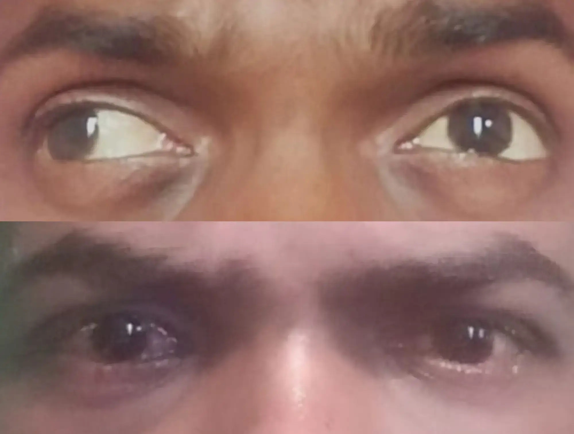 Adult Squint Surgery